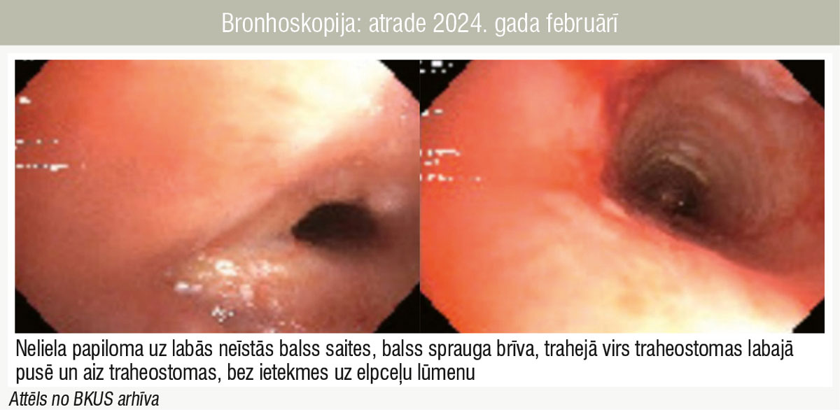 Bronhoskopija: atrade 2024. gada februārī