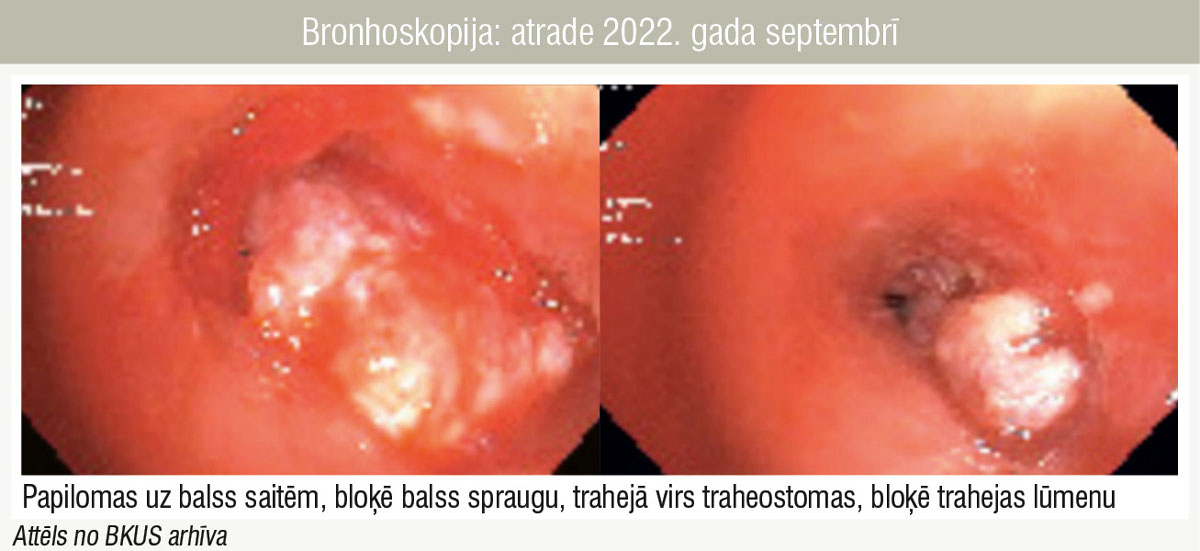 Bronhoskopija: atrade 2022. gada septembrī