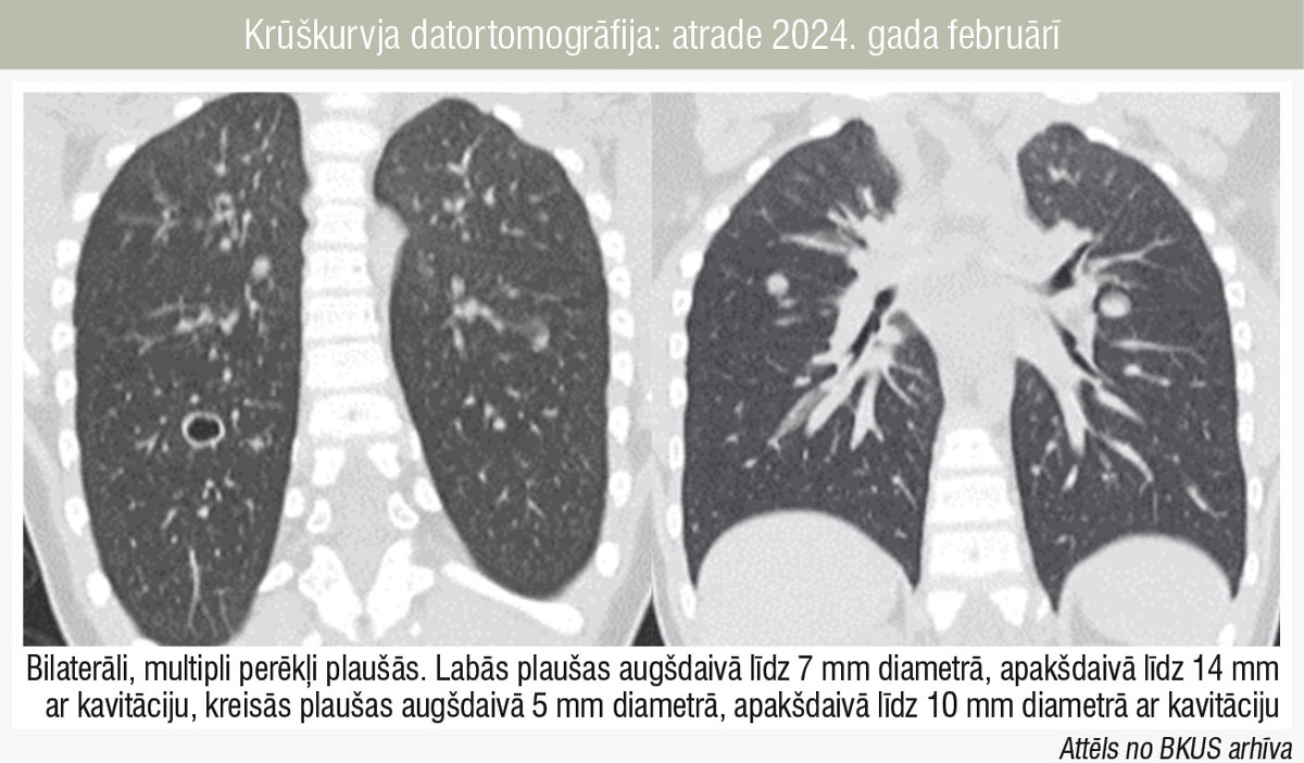 Krūškurvja datortomogrāfija: atrade 2024. gada februārī