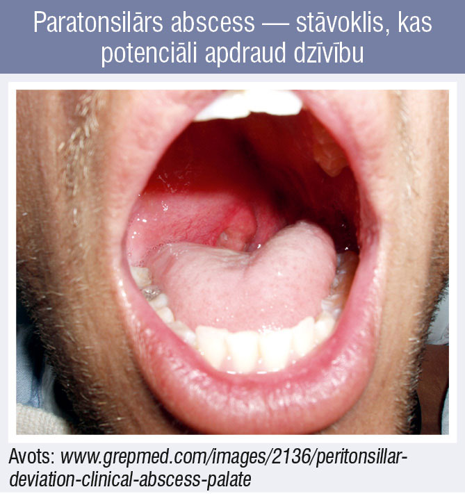 Paratonsilārs abscess — stāvoklis, kas potenciāli apdraud dzīvību