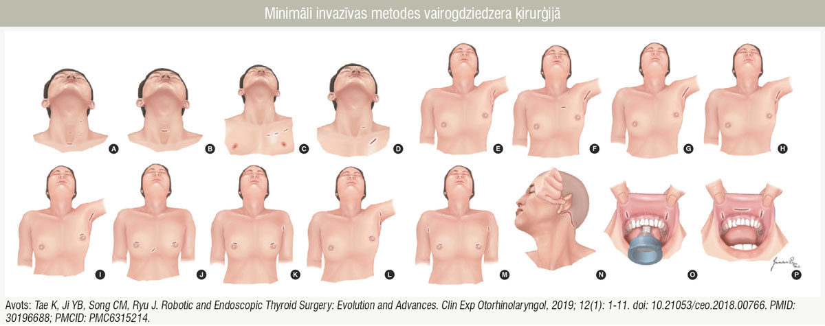 Minimāli invazīvas metodes vairogdziedzera ķirurģijā