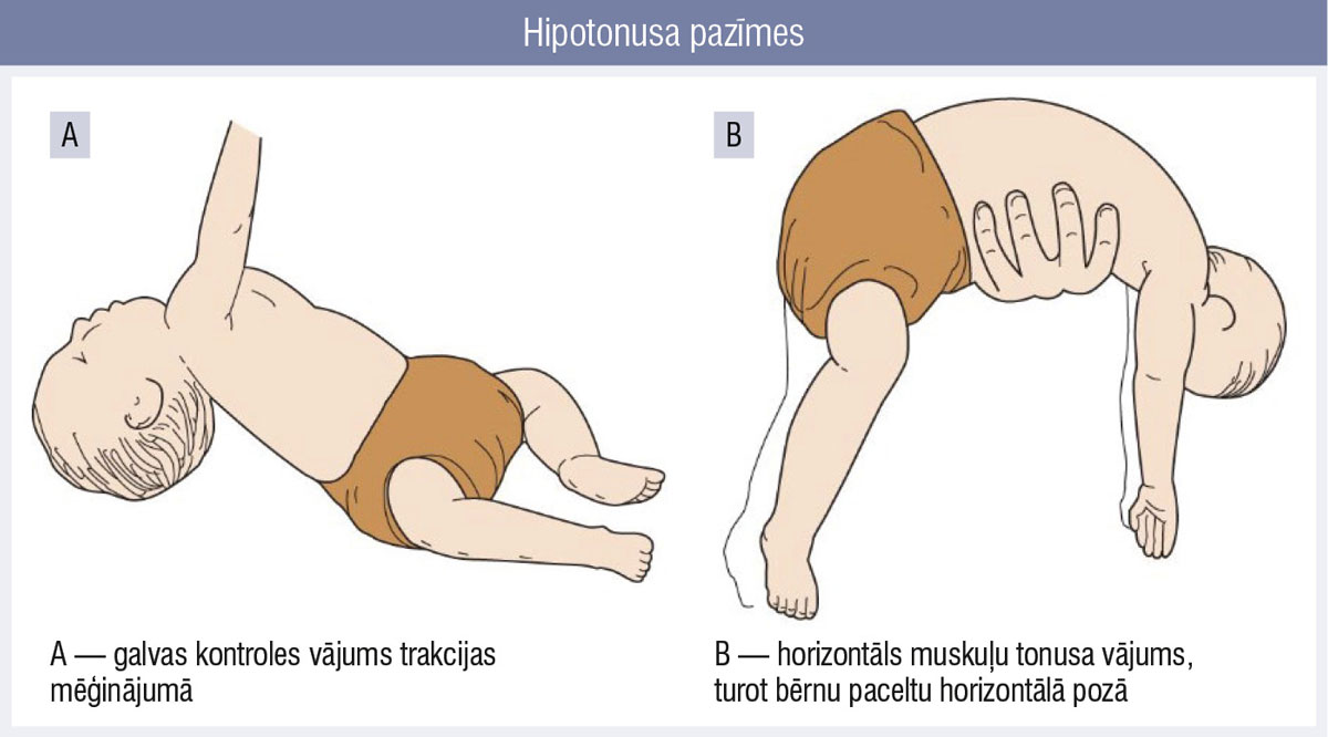 Hipotonusa pazīmes