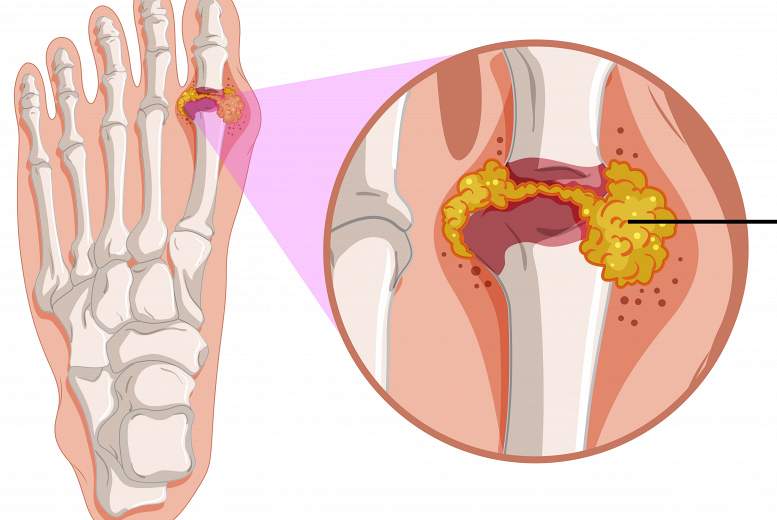 Podagra. Neārstējot — riski ir augsti