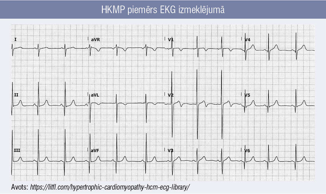 HKMP piemērs EKG izmeklējumā