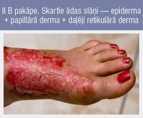 II B pakāpe. Skartie ādas slāņi — epiderma + papillārā derma + daļēji retikulārā derma