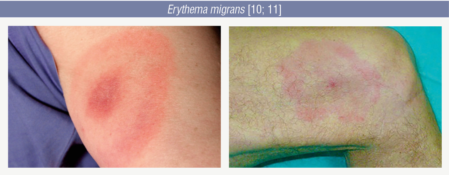 Erythema migrans [10; 11]