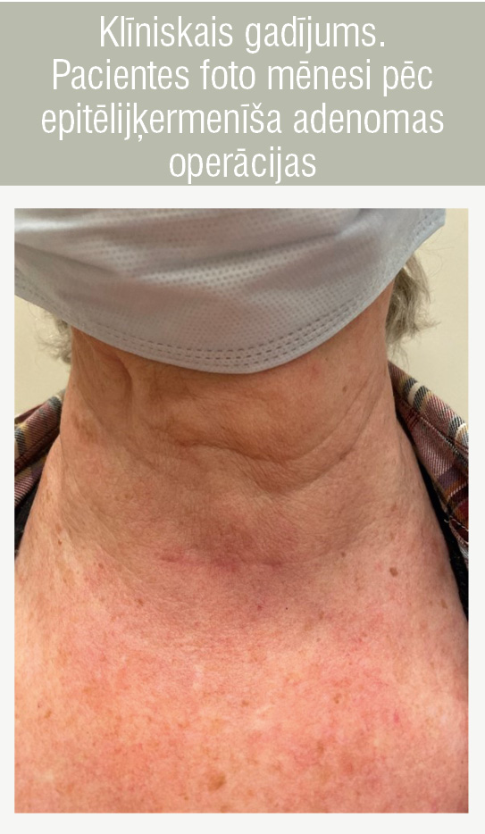 Klīniskais gadījums.
Pacientes foto mēnesi pēc epitēlijķermenīša adenomas operācijas