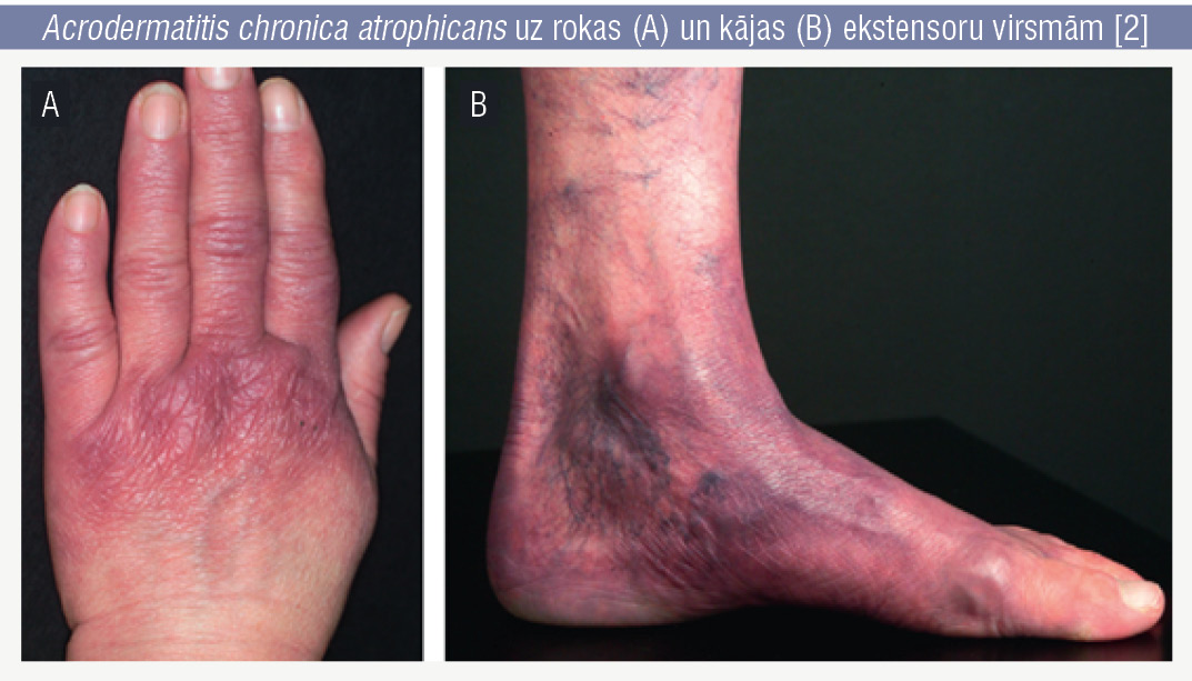 Acrodermatitis chronica atrophicans uz rokas (A) un kājas (B) ekstensoru virsmām [2]