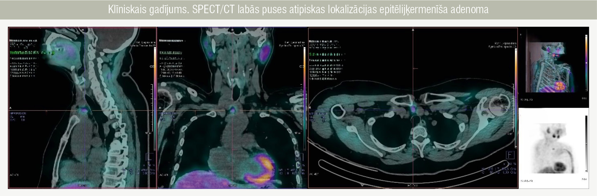 Klīniskais gadījums. SPECT/CT labās puses atipiskas lokalizācijas epitēlijķermenīša adenoma