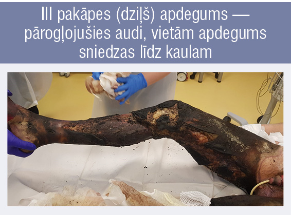 II A pakāpes (virspusējs) apdegums. Eksudatīva, mitra, sāpīga, eritematoza brūce, redzamas bullas