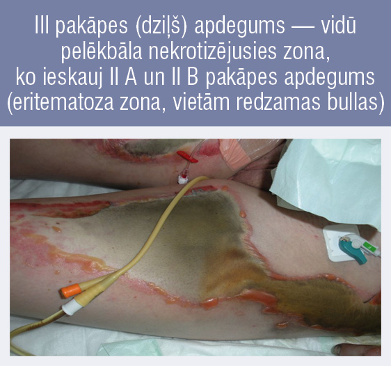 III pakāpes (dziļš) apdegums — vidū pelēkbāla nekrotizējusies zona, ko ieskauj II A un II B pakāpes apdegums (eritematoza zona, vietām redzamas bullas)