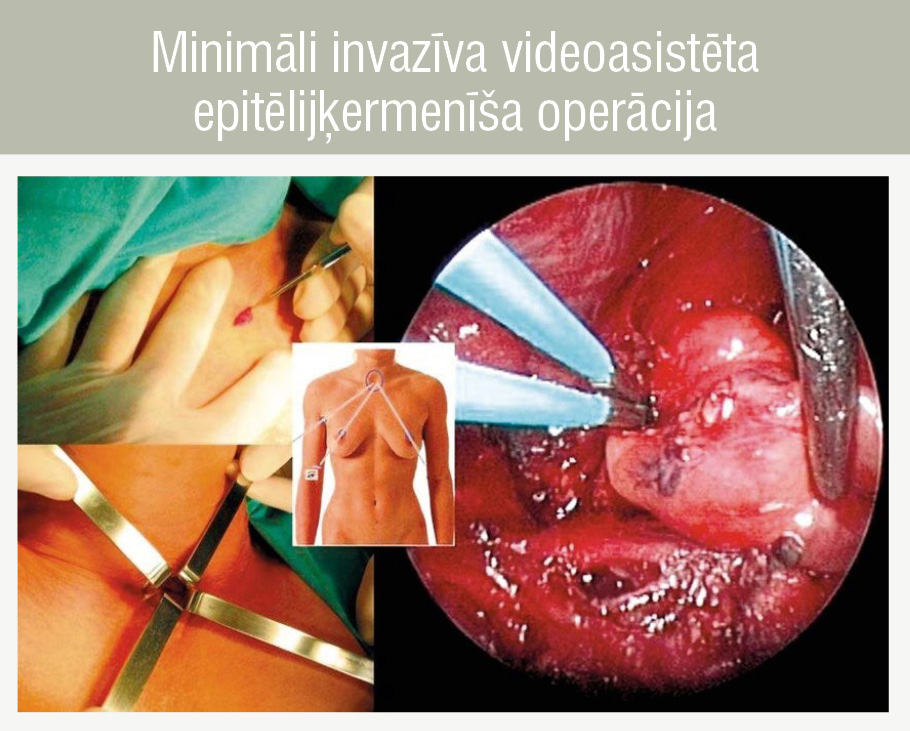 Minimāli invazīva videoasistēta epitēlijķermenīša operācija