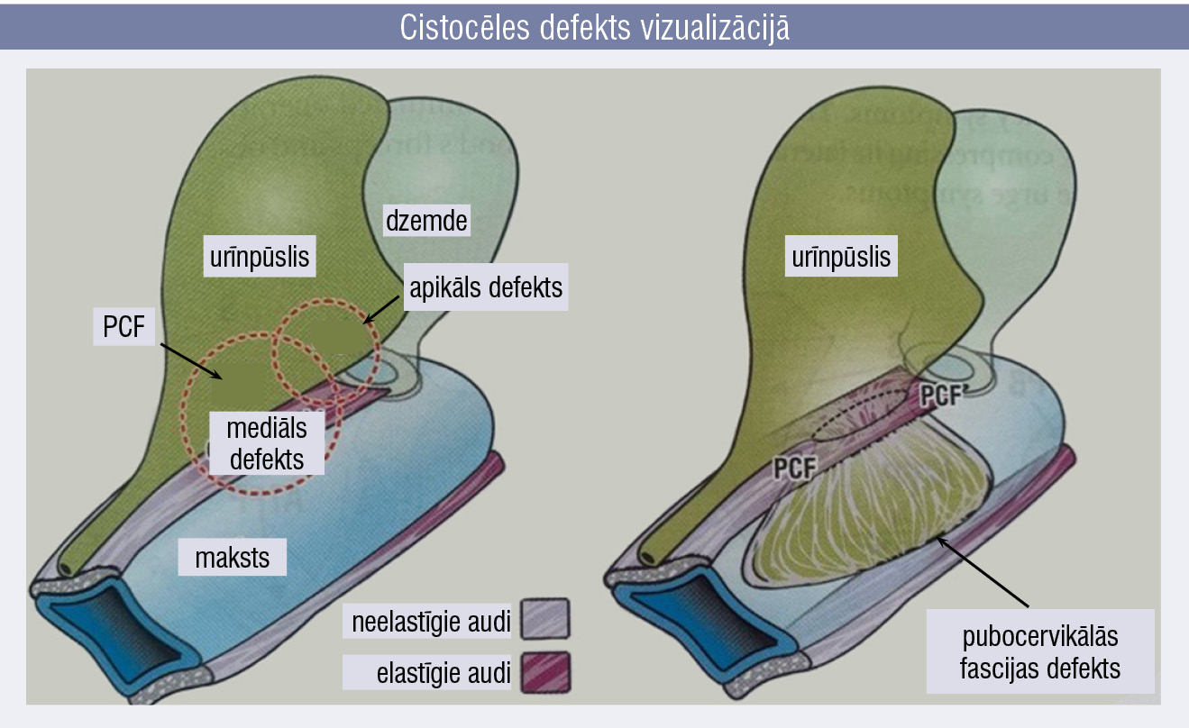 Cistocēles defekts vizualizācijā
