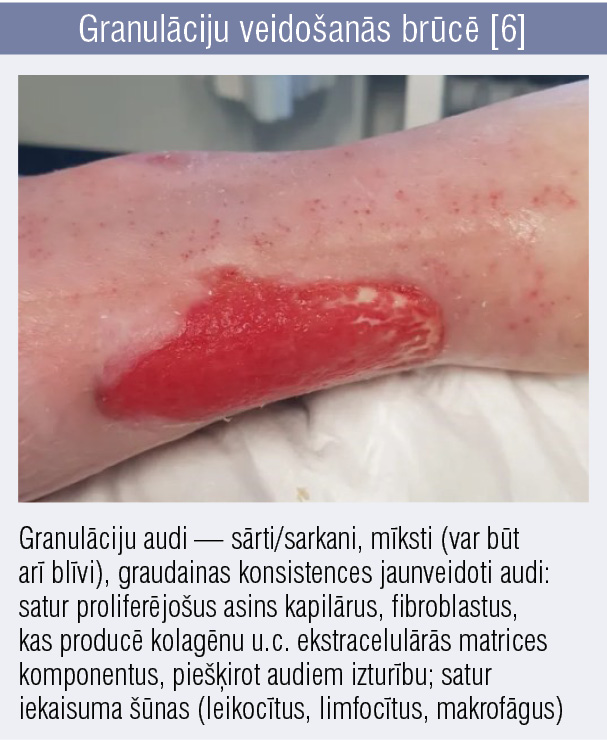 Granulāciju veidošanās brūcē [6]