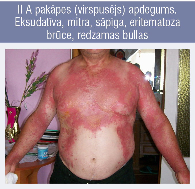II A pakāpes (virspusējs) apdegums. Eksudatīva, mitra, sāpīga, eritematoza brūce, redzamas bullas