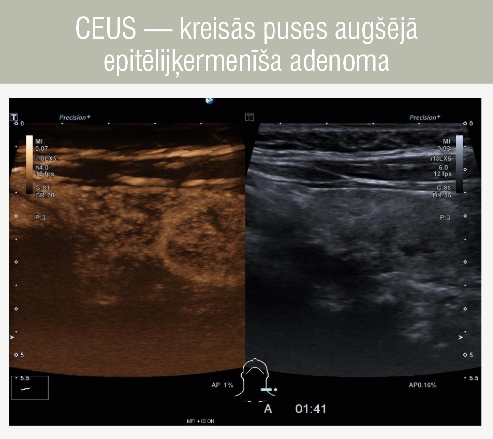 CEUS — kreisās puses augšējā epitēlijķermenīša adenoma