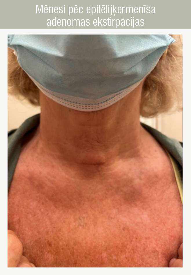 Mēnesi pēc epitēlijķermenīša
adenomas ekstirpācijas