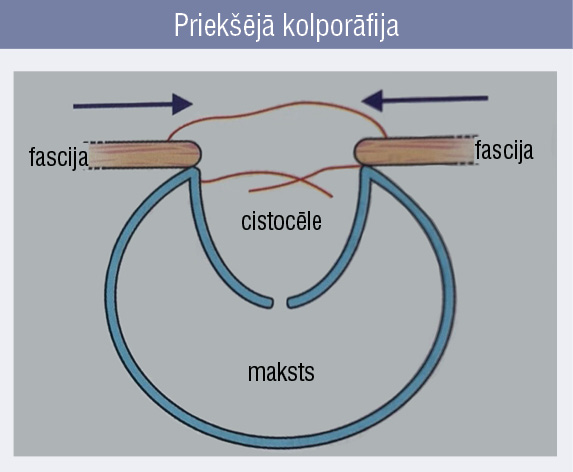 Priekšējā kolporāfija