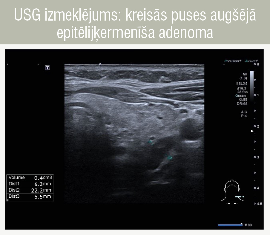 USG izmeklējums: kreisās puses augšējā epitēlijķermenīša adenoma