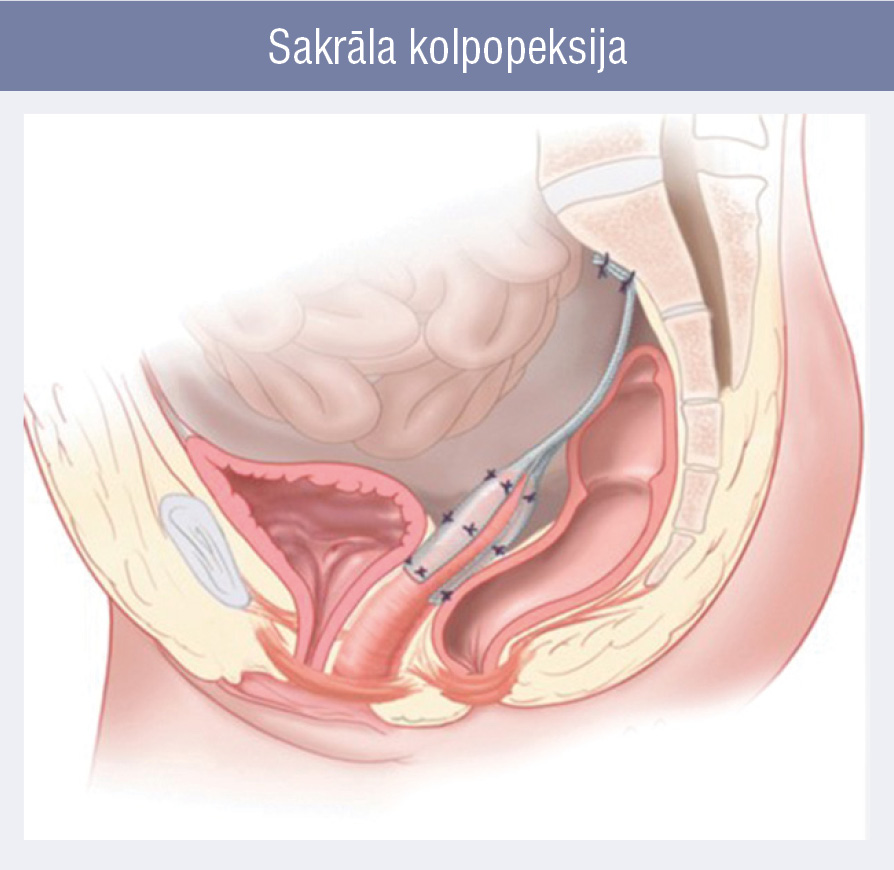 Sakrāla kolpopeksija