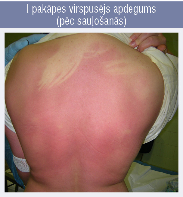 I pakāpes virspusējs apdegums
(pēc sauļošanās)