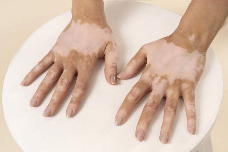 Vitiligo saistīts ar autoimūnām slimībām, galvenokārt vairogdziedzera slimībām un psoriāzi