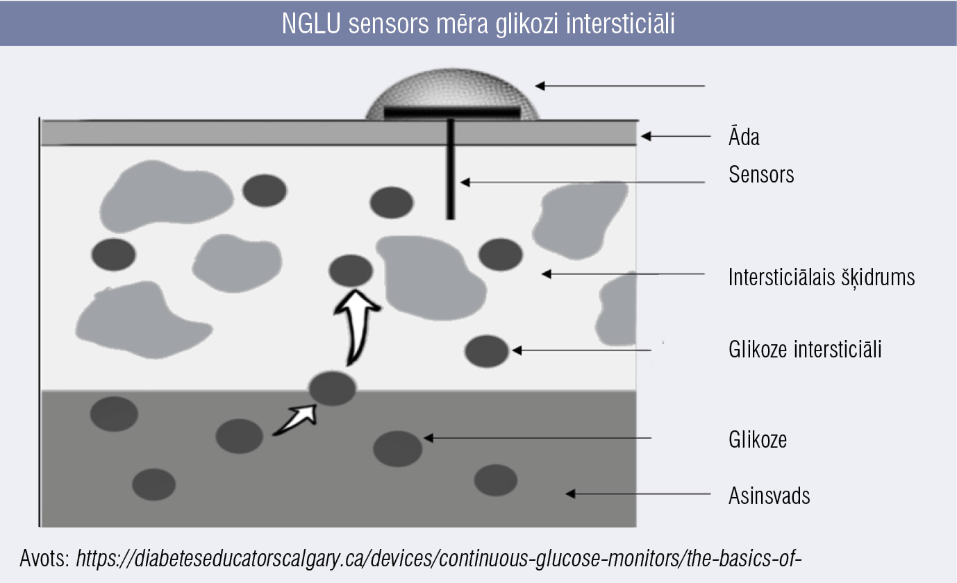 NGLU sensors mēra glikozi intersticiāli