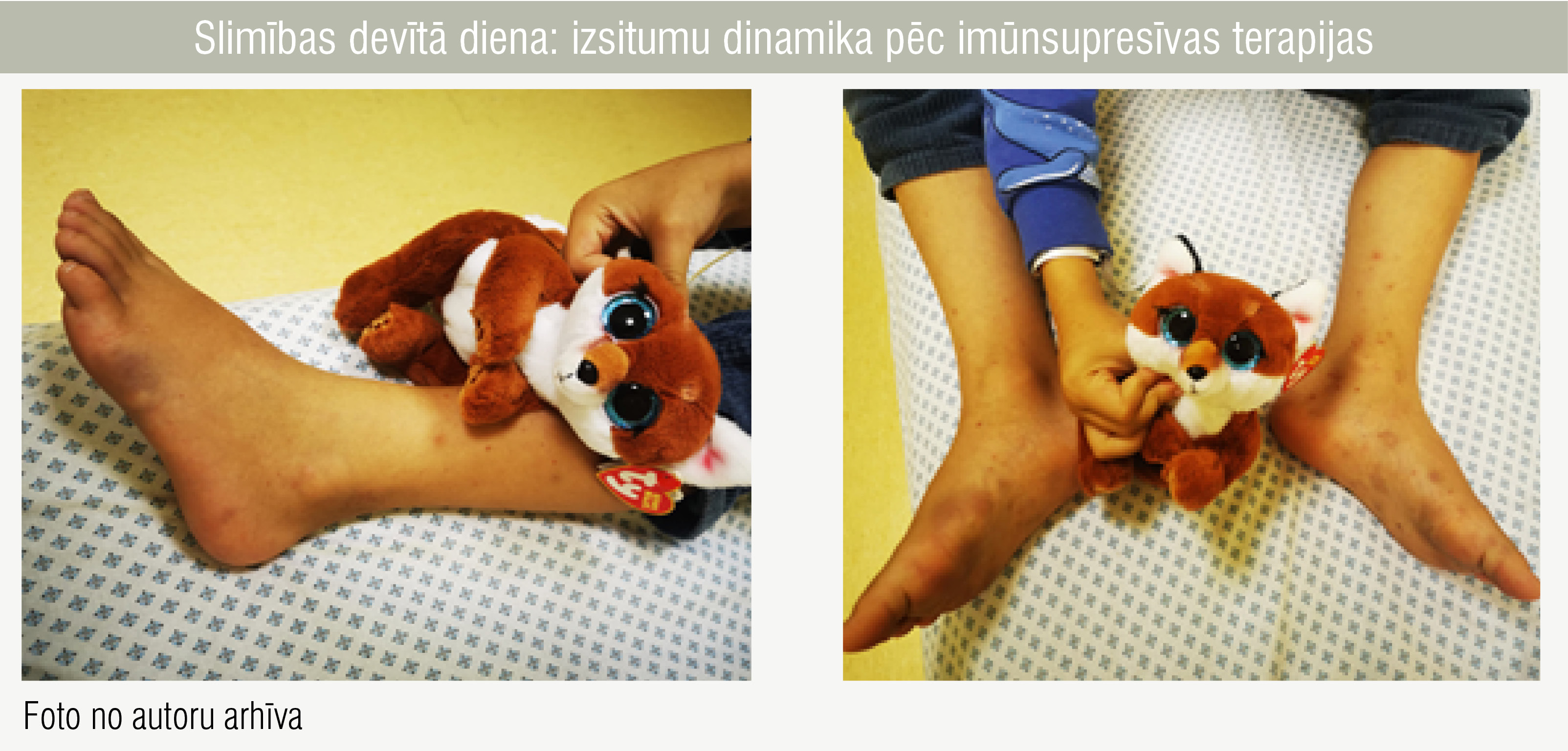 Slimības devītā diena: izsitumu dinamika pēc imūnsupresīvas terapijas