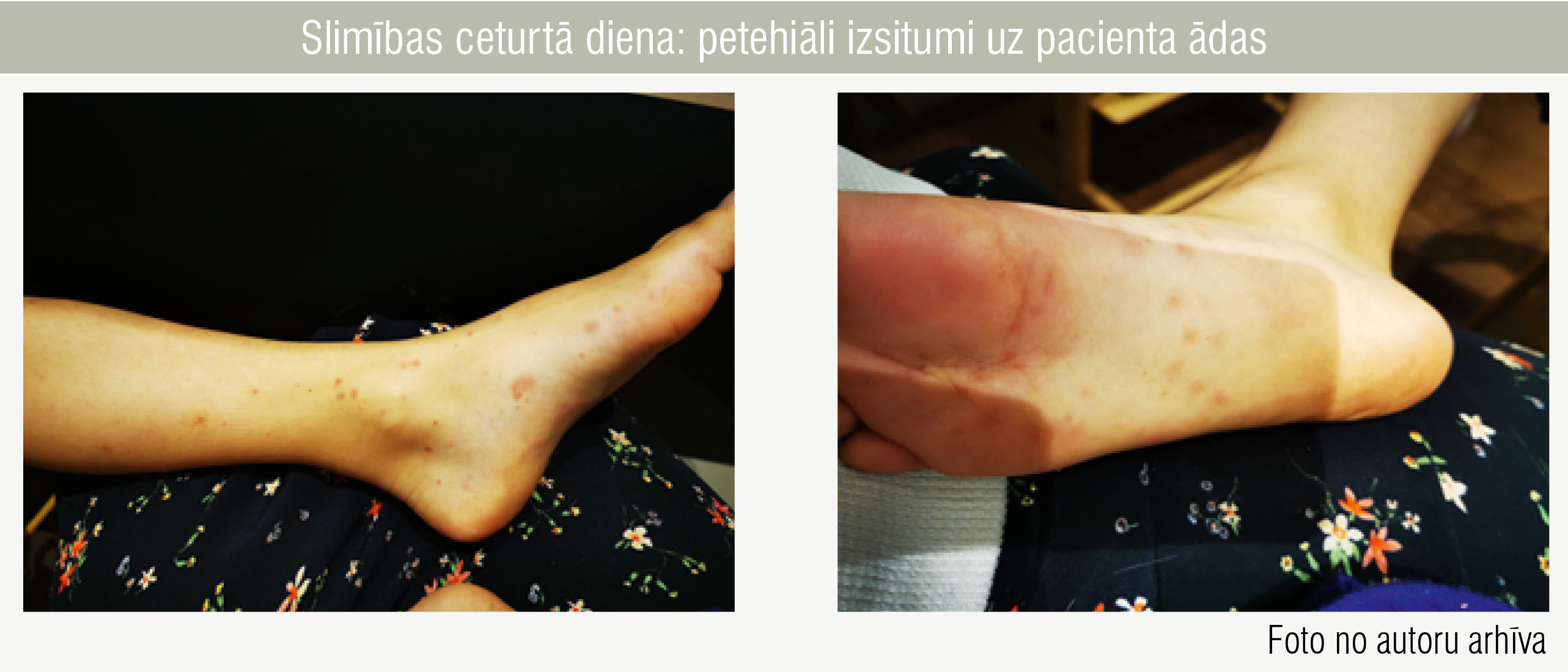 Slimības ceturtā diena: petehiāli izsitumi uz pacienta ādas