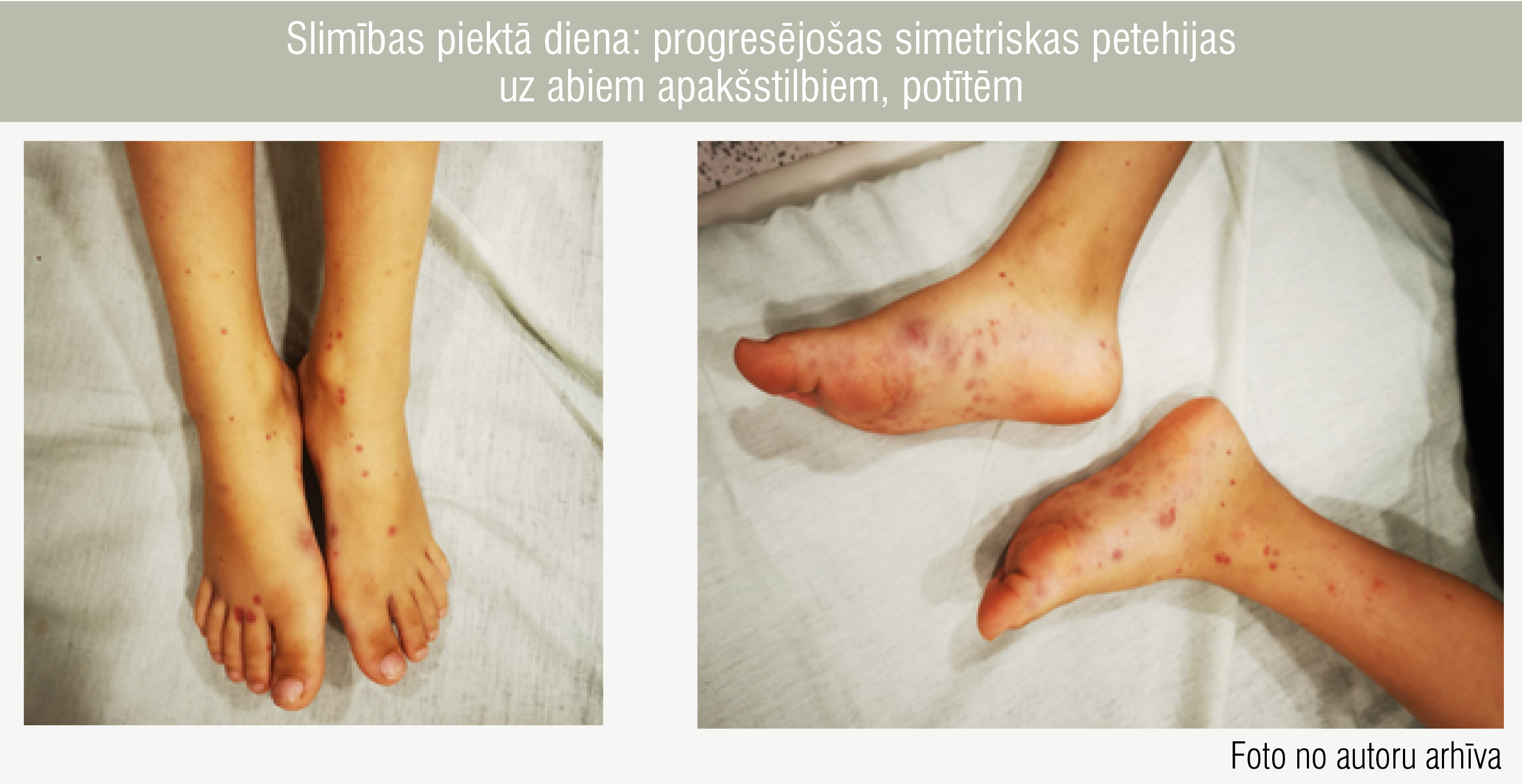 Slimības piektā diena: progresējošas simetriskas petehijas uz abiem apakšstilbiem, potītēm