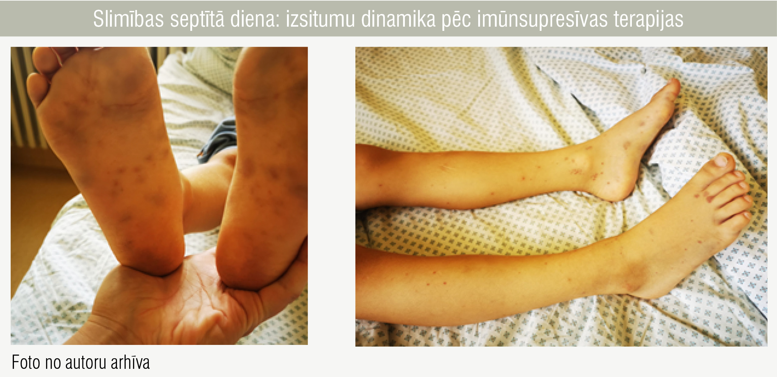 Slimības septītā diena: izsitumu dinamika pēc imūnsupresīvas terapijas