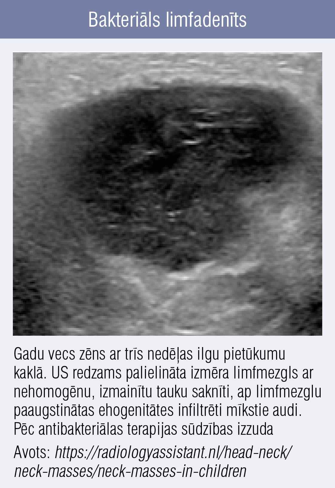 Bakteriāls limfadenīts