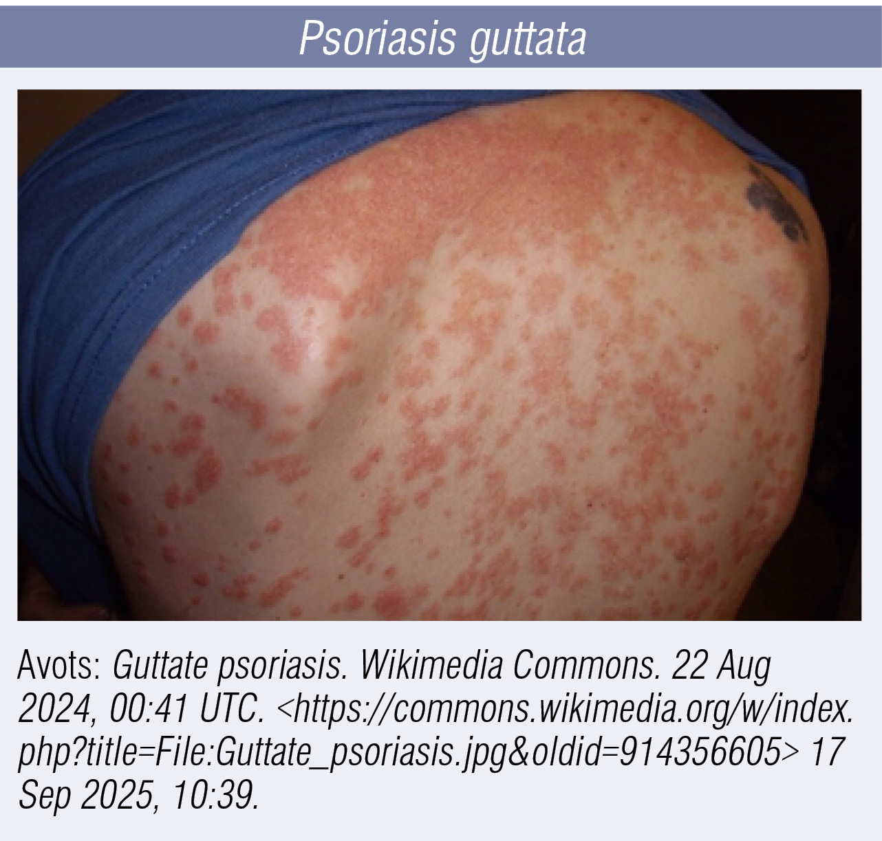 Psoriasis guttata