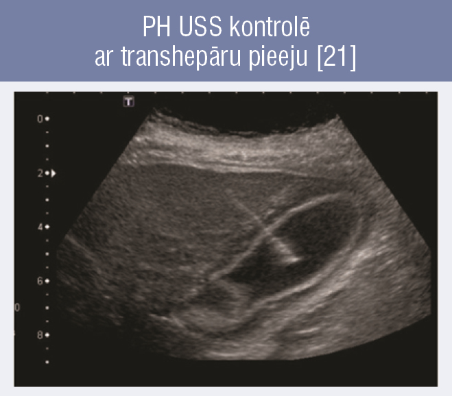 PH USS kontrolē ar transhepāru pieeju [21]