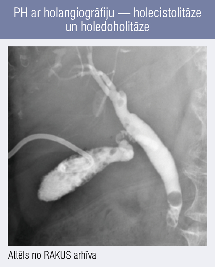 PH ar holangiogrāfiju — holecistolitāze un holedoholitāze