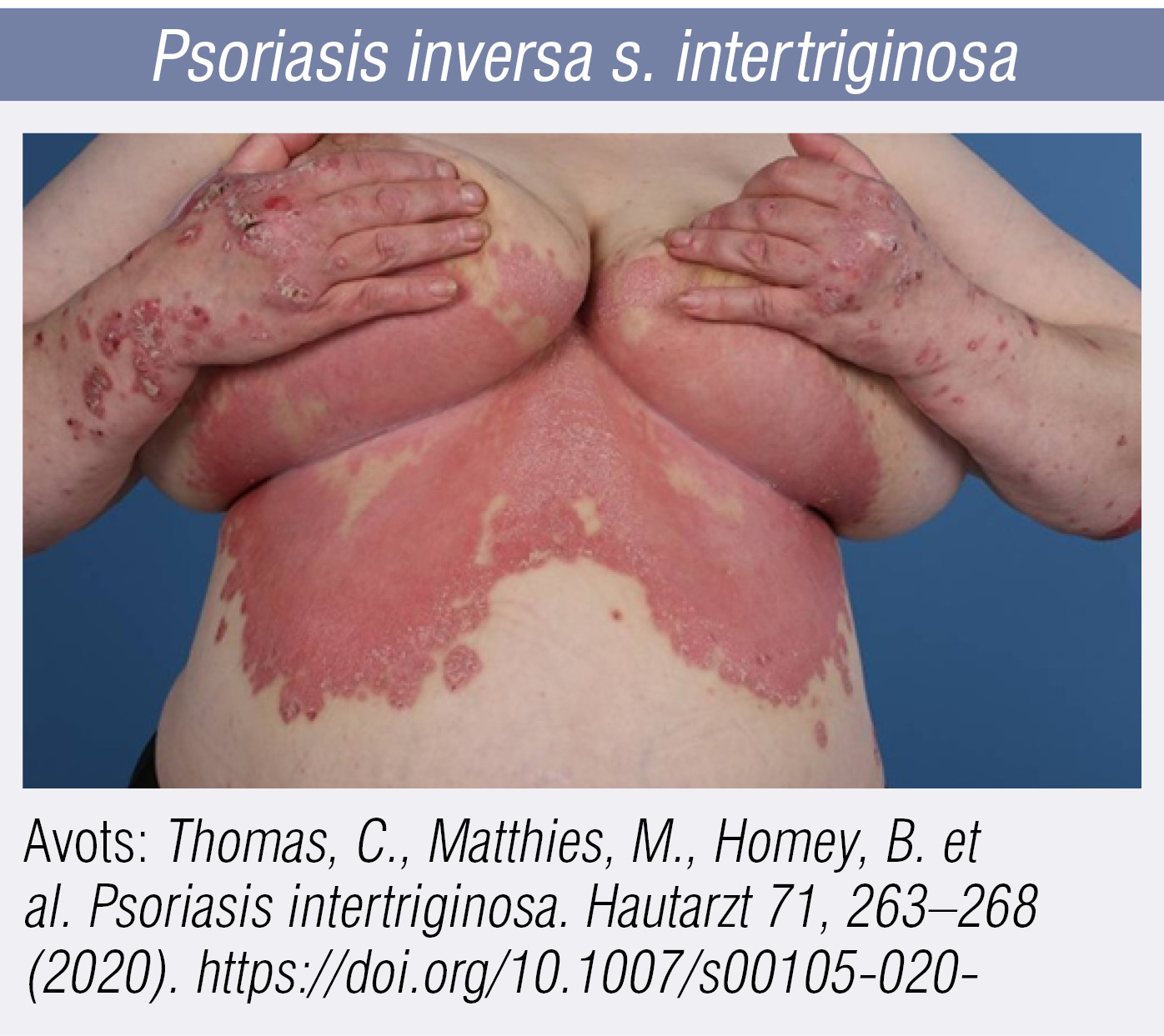 Psoriasis inversa s. intertriginosa