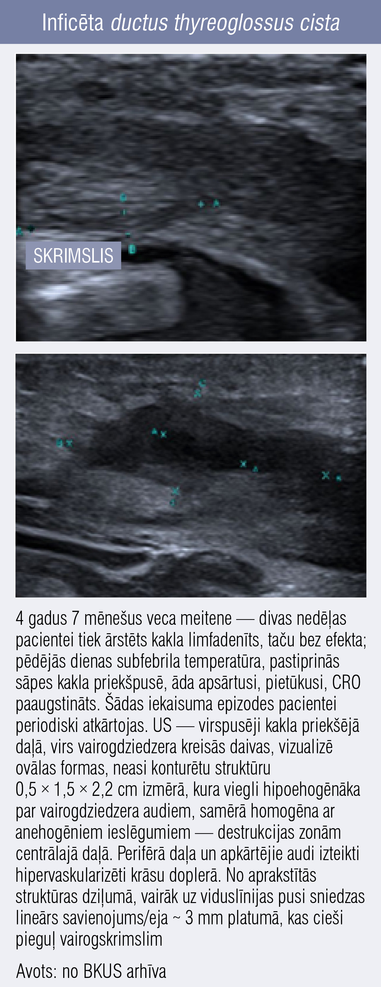 Inficēta ductus thyreoglossus cista