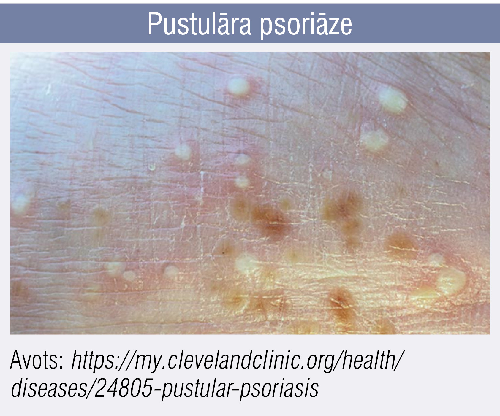 Pustulāra psoriāze