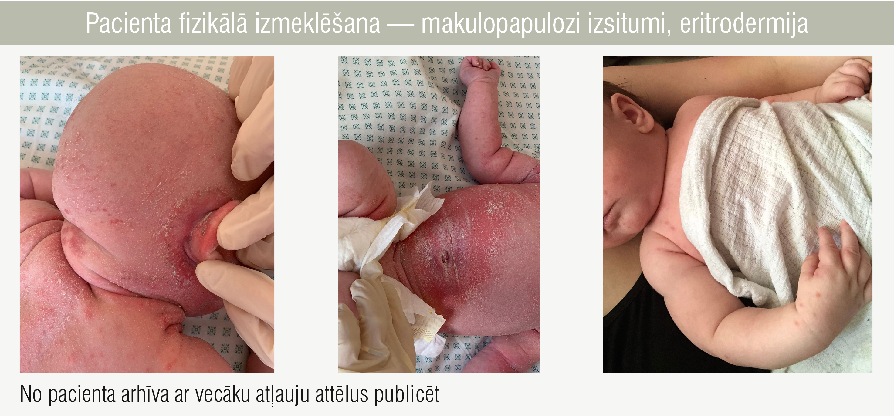 Pacienta fizikālā izmeklēšana — makulopapulozi izsitumi, eritrodermija