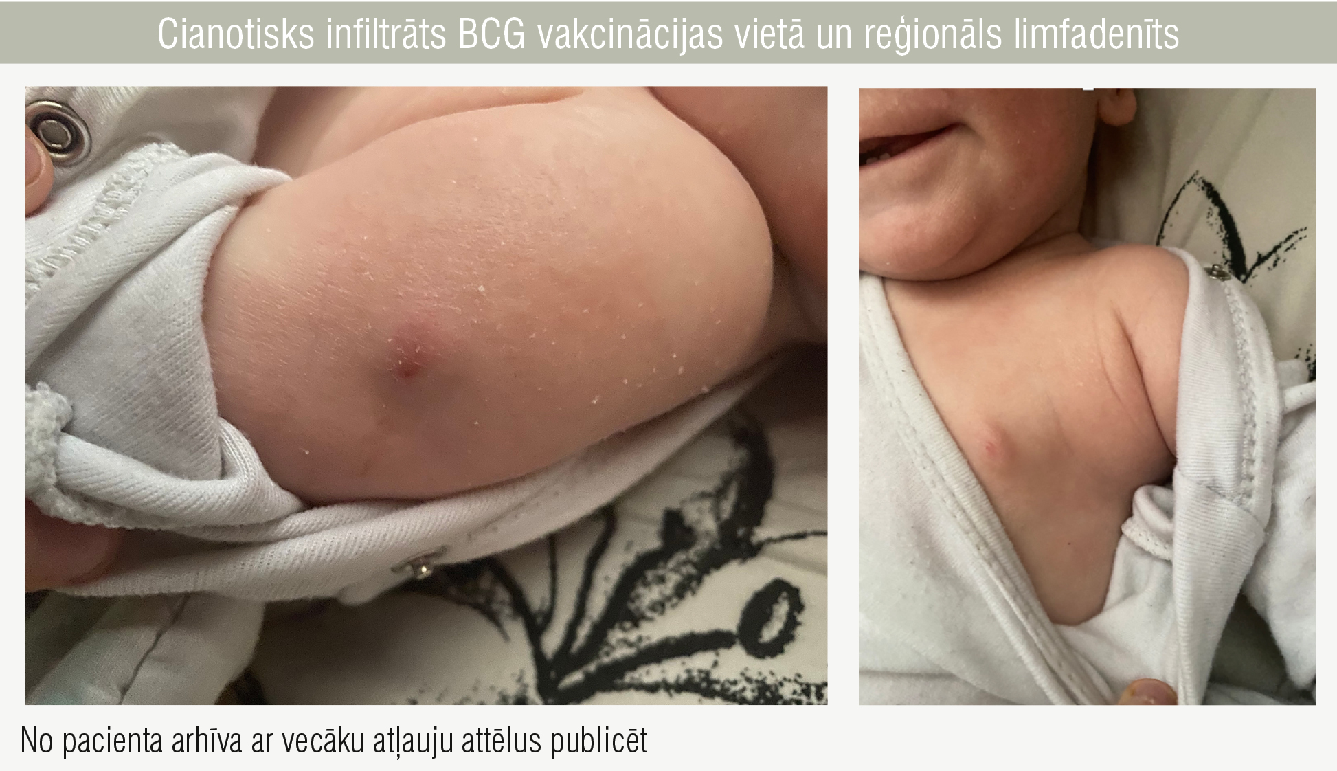 Cianotisks infiltrāts BCG vakcinācijas vietā un reģionāls limfadenīts