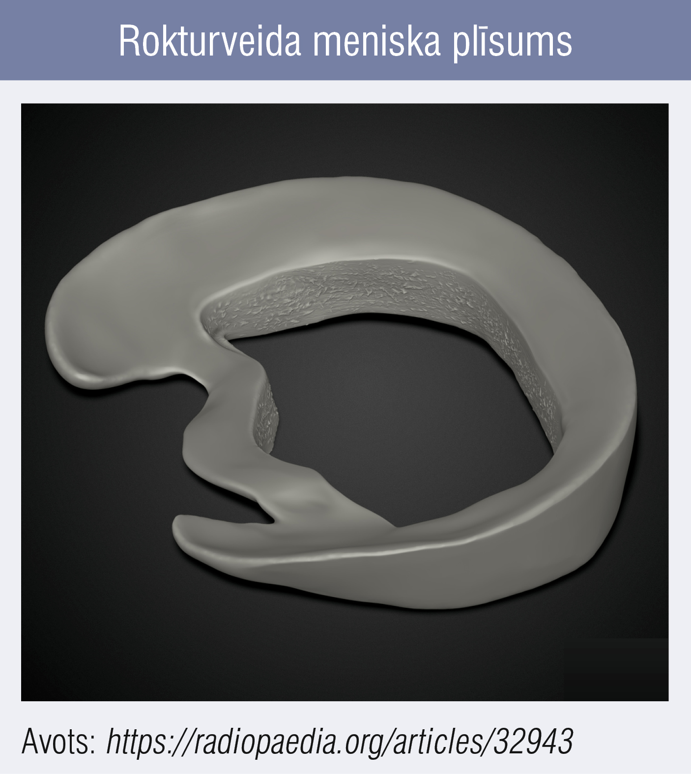 Rokturveida meniska plīsums