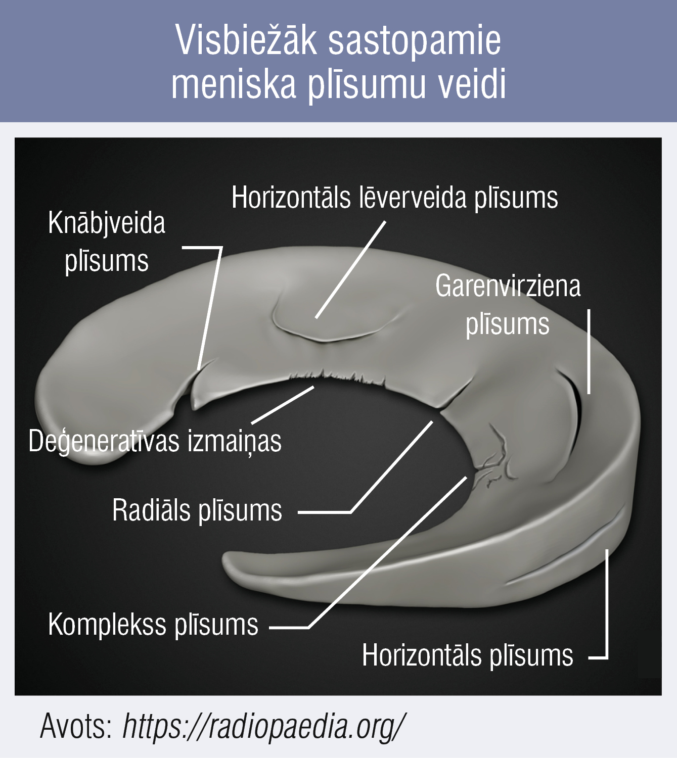 Visbiežāk sastopamie meniska plīsumu veidi