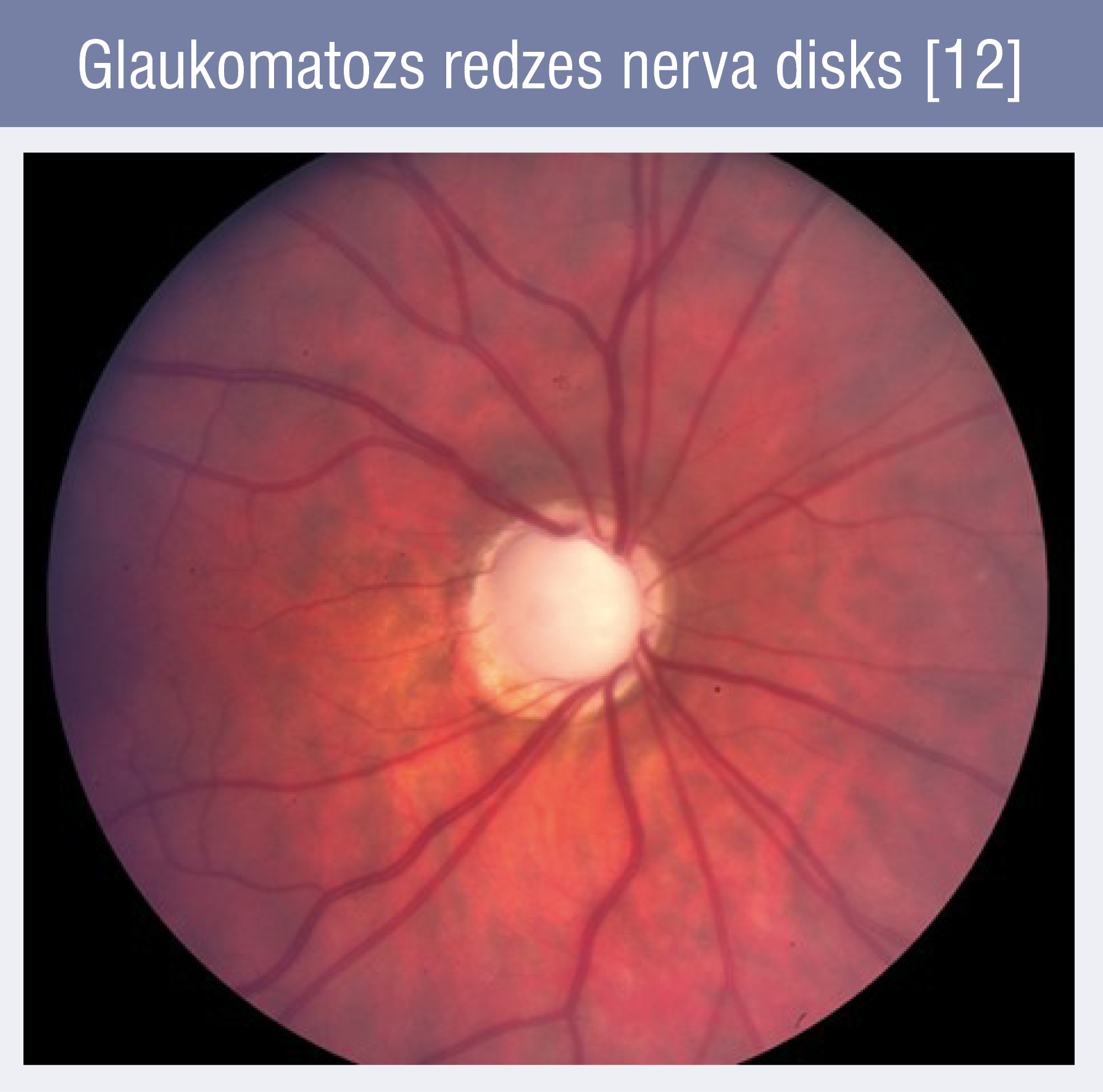 Glaukomatozs redzes nerva disks [12]