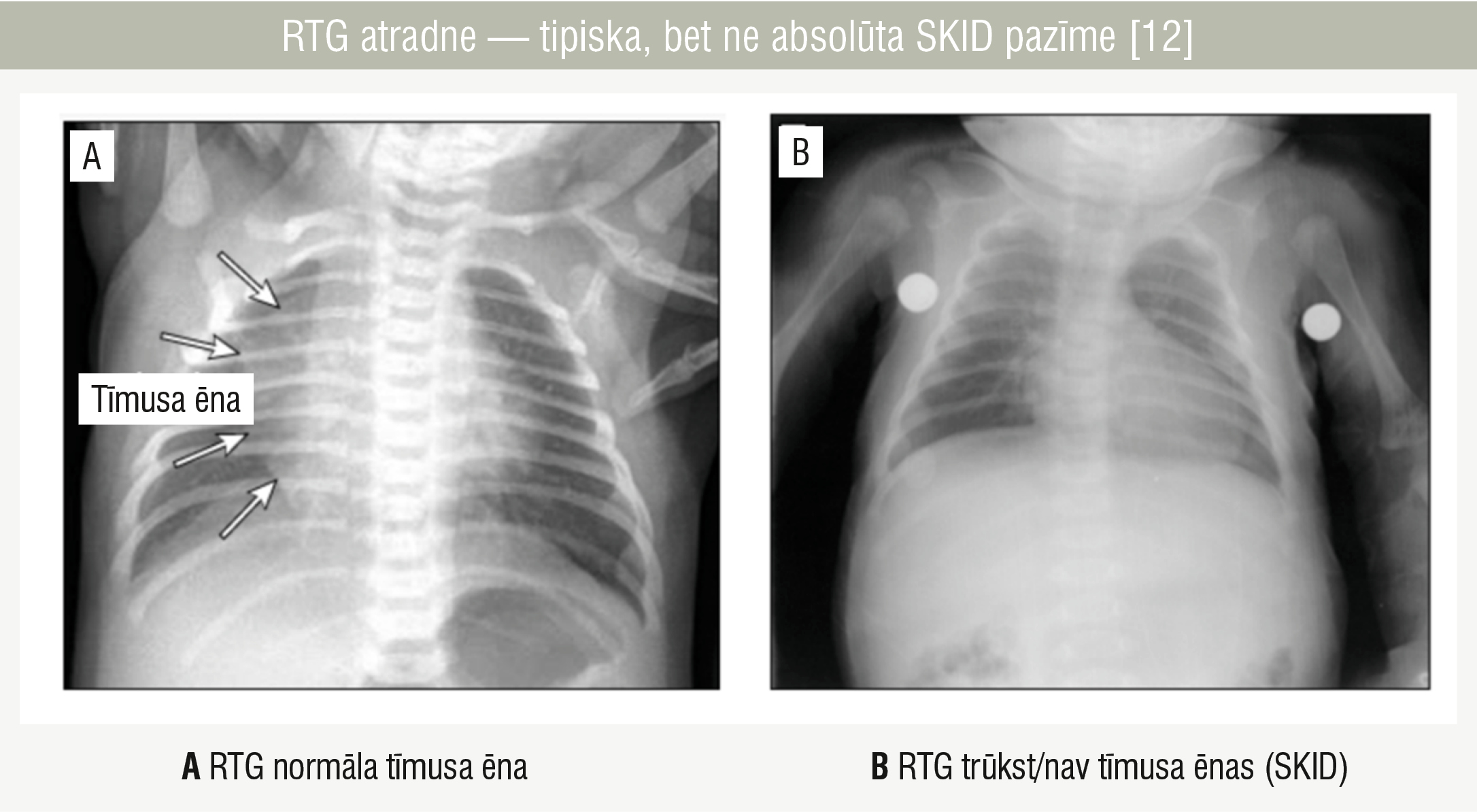 RTG atradne — tipiska, bet ne absolūta SKID pazīme [12]