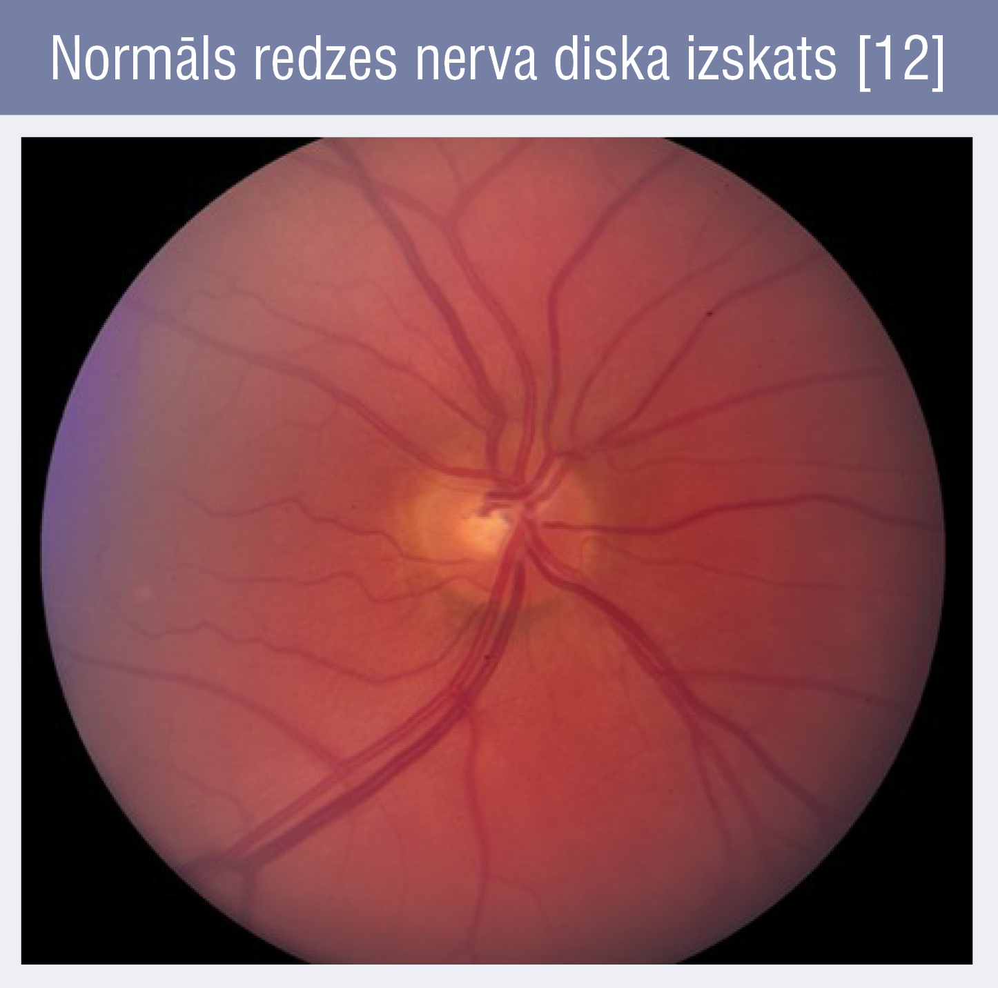 Normāls redzes nerva diska izskats [12]