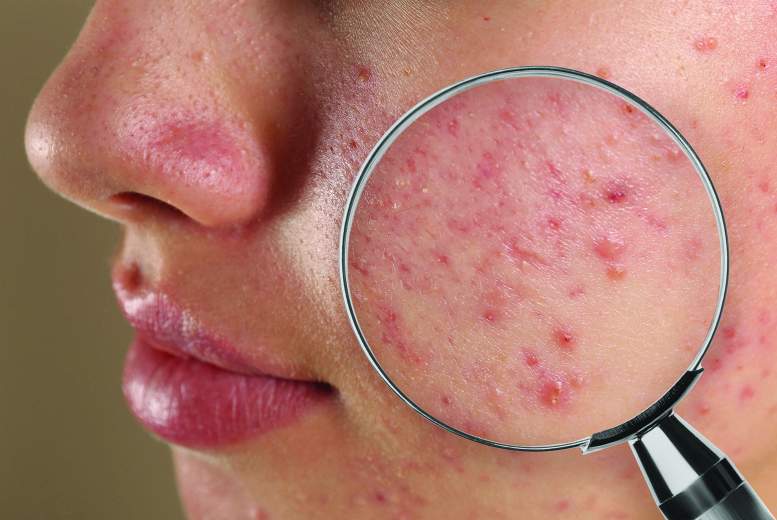 <em>Acne vulgaris</em>. Ieskats šī brīža rekomendācijās