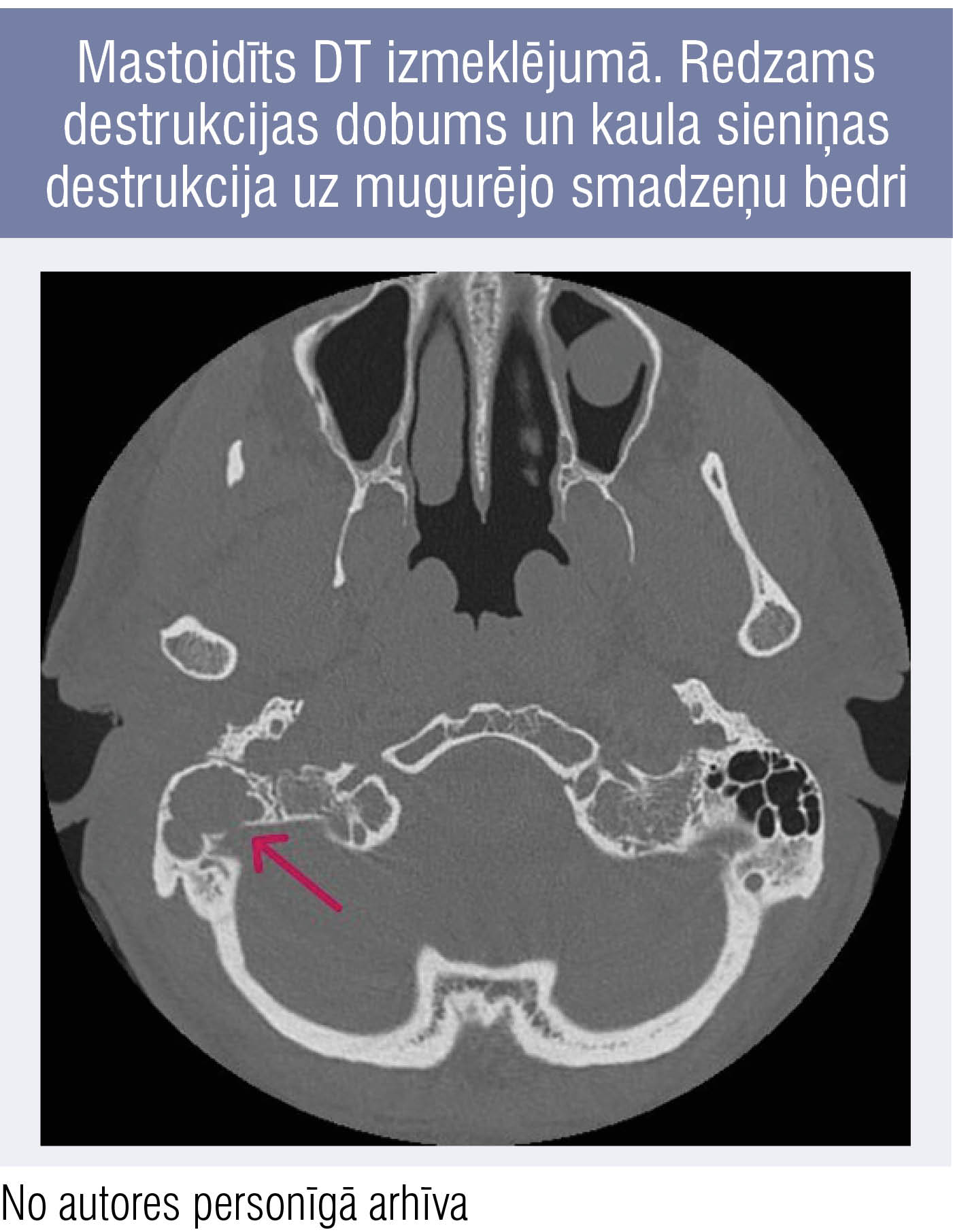 Mastoidīts DT izmeklējumā. Redzams destrukcijas dobums un kaula sieniņas destrukcija uz mugurējo smadzeņu bedri