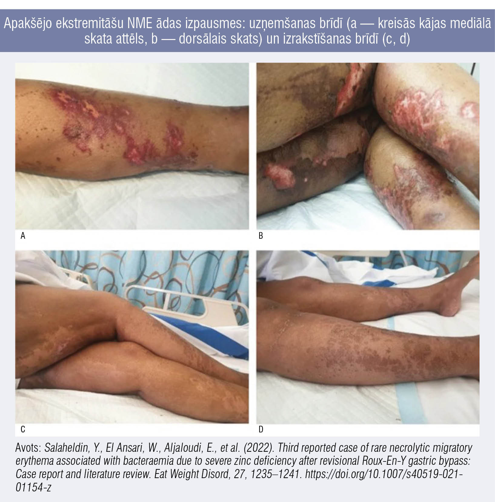 Apakšējo ekstremitāšu NME ādas izpausmes: uzņemšanas brīdī (a — kreisās kājas mediālā skata attēls, b — dorsālais skats) un izrakstīšanas brīdī (c, d)