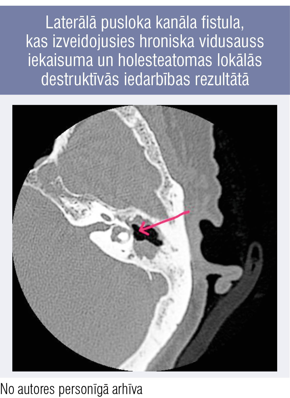 Laterālā pusloka kanāla fistula, kas izveidojusies hroniska vidusauss iekaisuma un holesteatomas lokālās destruktīvās iedarbības rezultātā