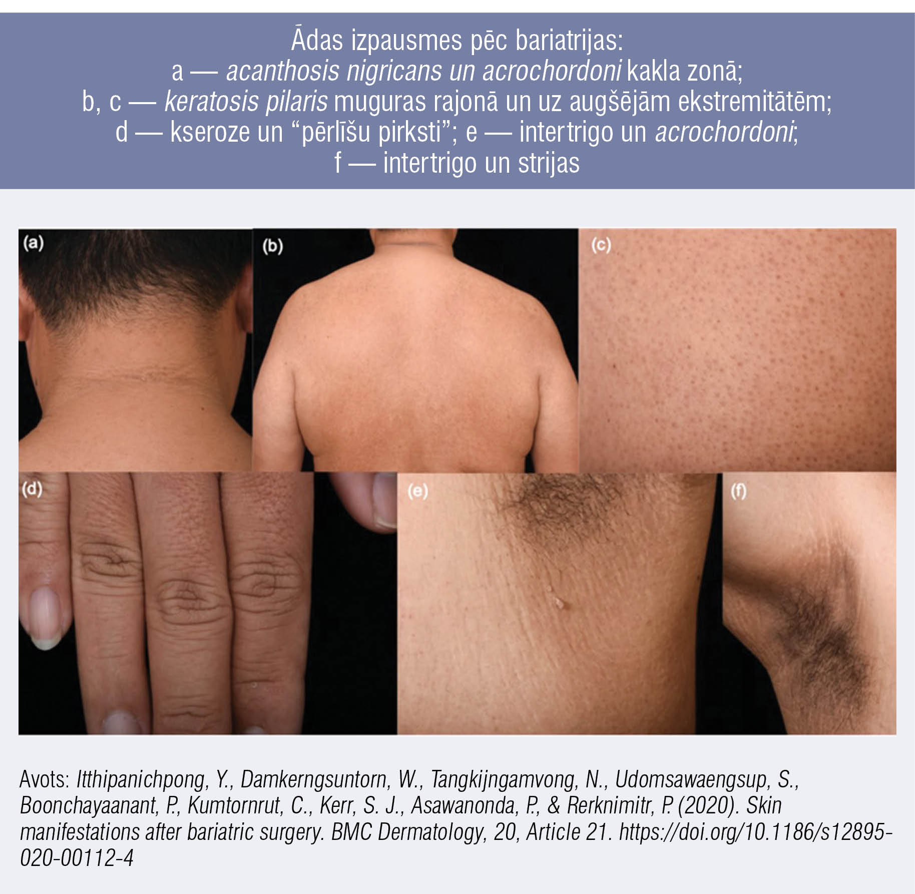 Ādas izpausmes pēc bariatrijas: a — acanthosis nigricans un acrochordoni kakla zonā; b, c — keratosis pilaris muguras rajonā un uz augšējām ekstremitātēm; d — kseroze un “pērlīšu pirksti”; e — intertrigo un acrochordoni; f — intertrigo un strijas